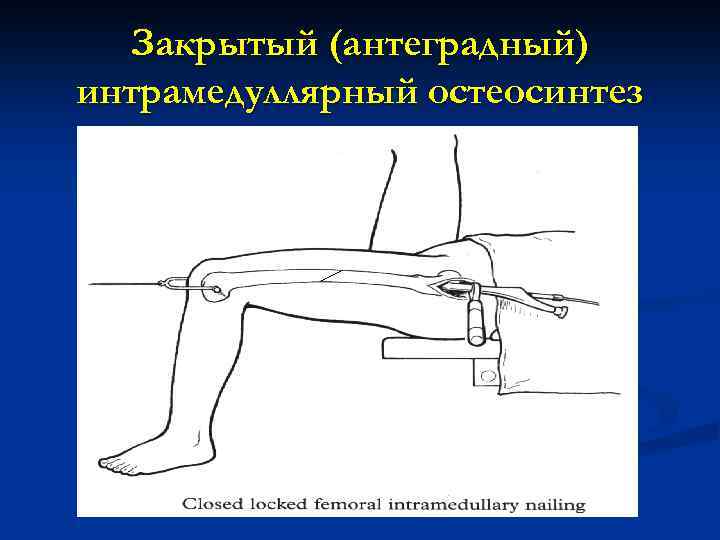 Закрытый (антеградный) интрамедуллярный остеосинтез 