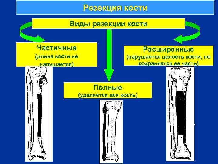 Резекция кости Виды резекции кости Частичные Расширенные (длина кости не нарушается) (нарушается целость кости,