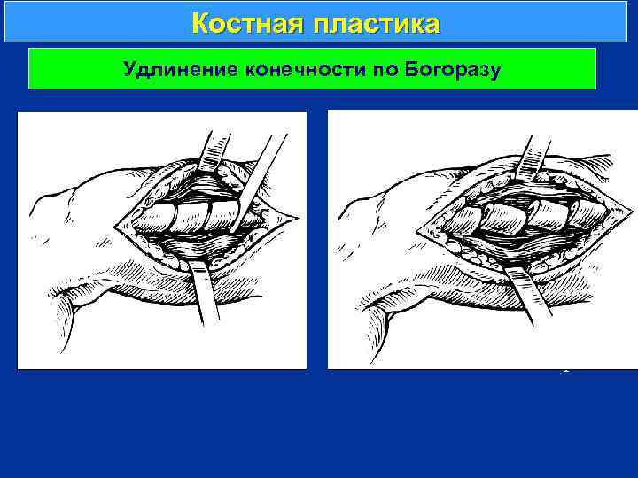 Костная пластика Удлинение конечности по Богоразу г 