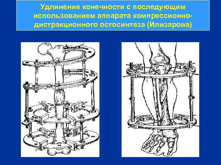 Удлинение конечности с последующим использованием аппарата компрессионнодистракционного остосинтеза (Илизарова) 