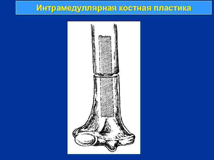 Интрамедуллярная костная пластика 