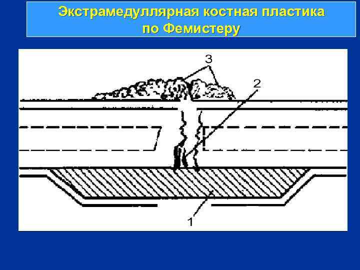 Экстрамедуллярная костная пластика по Фемистеру 