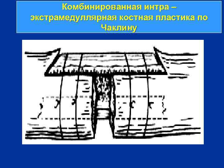 Комбинированная интра – экстрамедуллярная костная пластика по Чаклину 