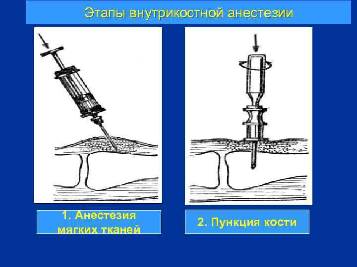 Этапы внутрикостной анестезии 1. Анестезия мягких тканей 2. Пункция кости 