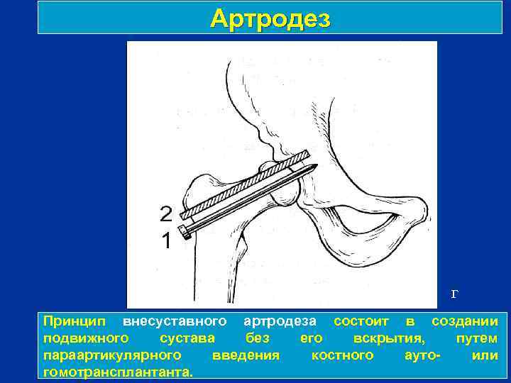 Артродез г Принцип внесуставного артродеза состоит в создании подвижного сустава без его вскрытия, путем