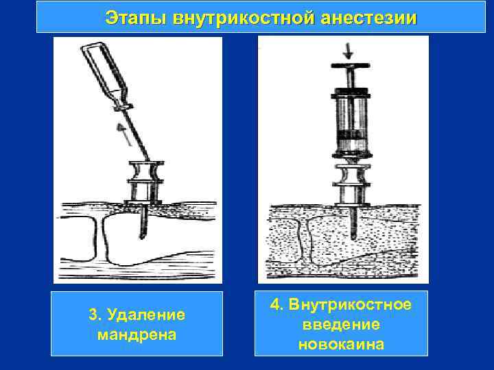 Этапы внутрикостной анестезии 3. Удаление мандрена 4. Внутрикостное введение новокаина 