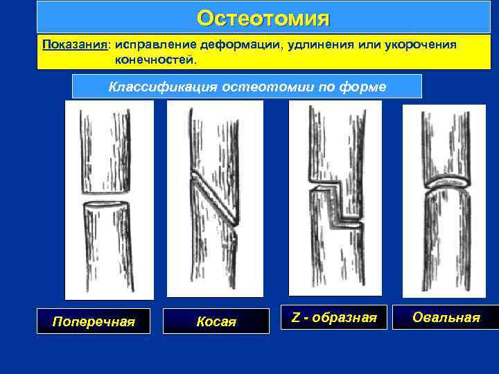 Остеотомия Показания: исправление деформации, удлинения или укорочения конечностей. Классификация остеотомии по форме г Поперечная