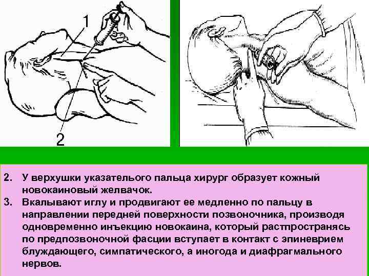 2. У верхушки указателього пальца хирург образует кожный новокаиновый желвачок. 3. Вкалывают иглу и