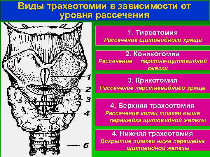 Виды трахеотомии в зависимости от уровня рассечения 1. Тиреотомия Рассечение щитовидного хряща 2. Коникотомия