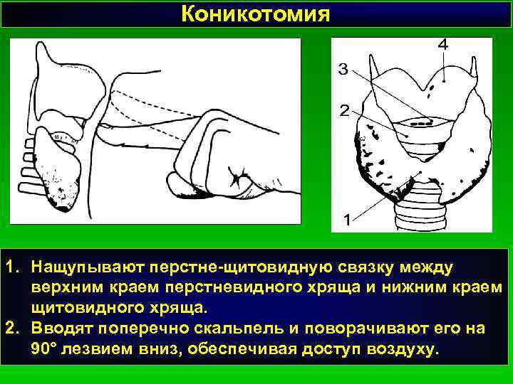 Коникотомия 1. Нащупывают перстне-щитовидную связку между верхним краем перстневидного хряща и нижним краем щитовидного