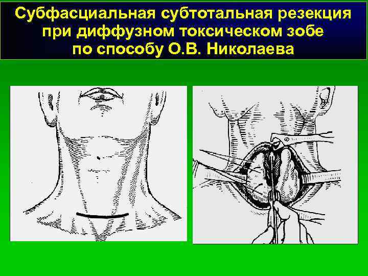 Субфасциальная субтотальная резекция при диффузном токсическом зобе по способу О. В. Николаева 