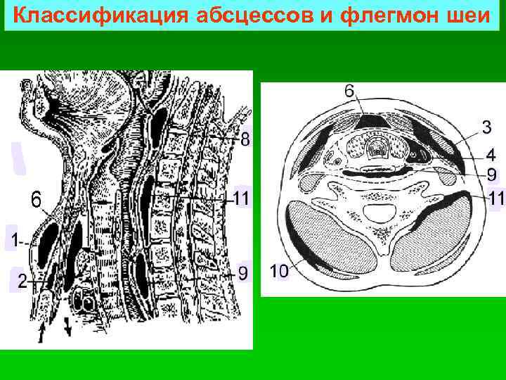 Классификация абсцессов и флегмон шеи 