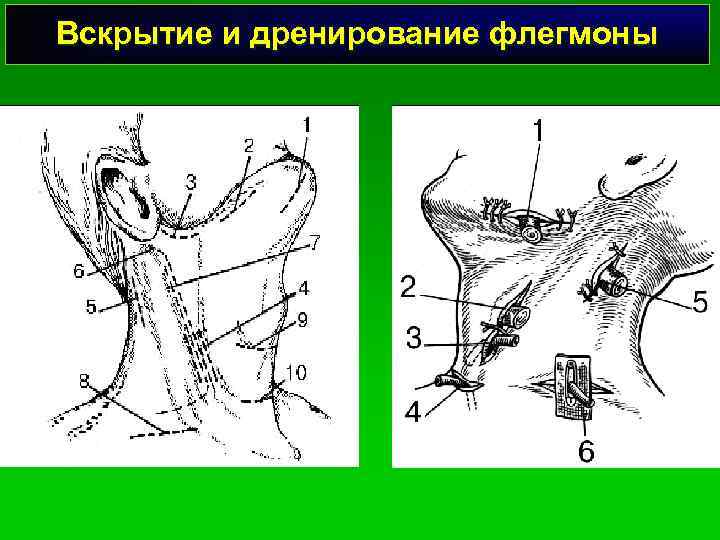 Вскрытие и дренирование флегмоны 