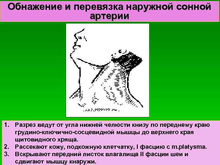 Обнажение и перевязка наружной сонной артерии 1. Разрез ведут от угла нижней челюсти книзу