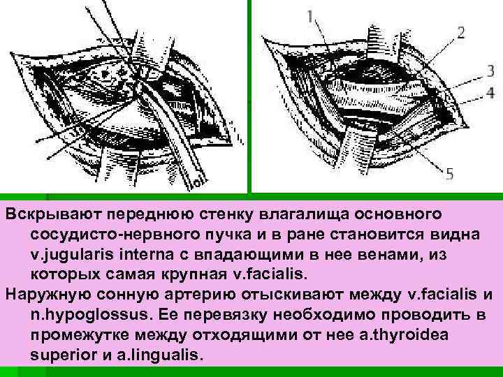Вскрывают переднюю стенку влагалища основного сосудисто-нервного пучка и в ране становится видна v. jugularis