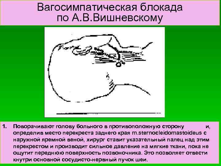 Вагосимпатическая блокада по А. В. Вишневскому 1. Поворачивают голову больного в противоположную сторону и,