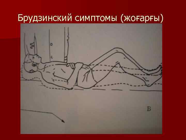 Брудзинский симптомы (жоғарғы) 