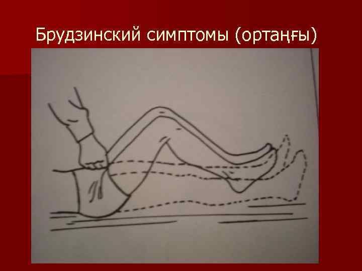 Брудзинский симптомы (ортаңғы) 