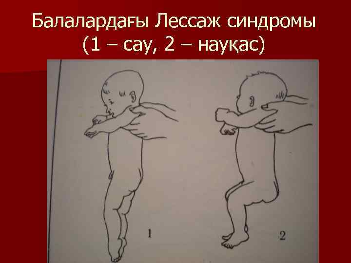Балалардағы Лессаж синдромы (1 – сау, 2 – науқас) 