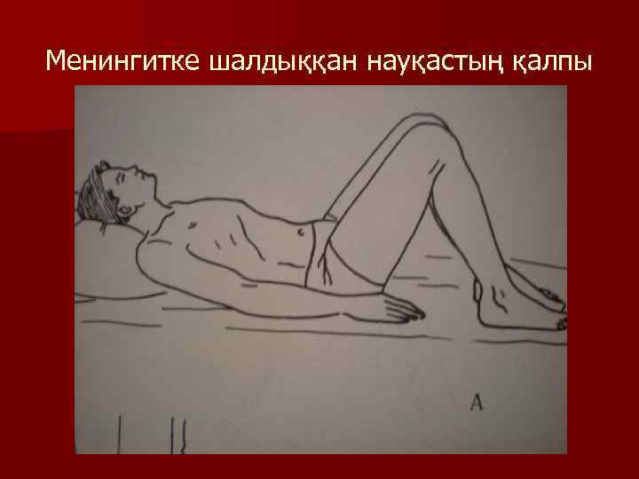 Менингитке шалдыққан науқастың қалпы 