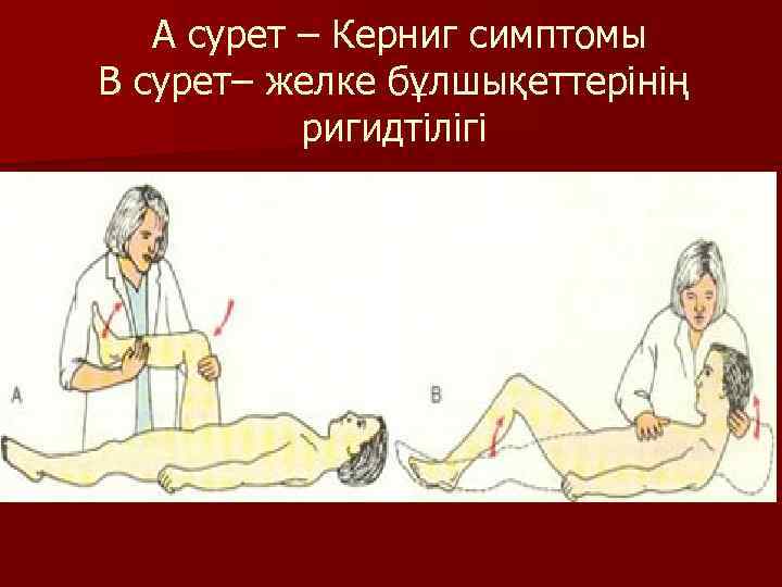  А сурет – Керниг симптомы В сурет– желке бұлшықеттерінің ригидтілігі 