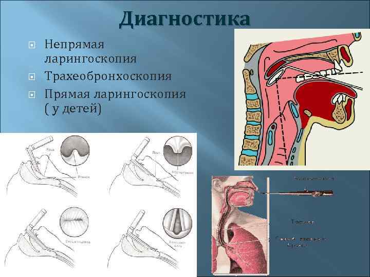 Диагностика Непрямая ларингоскопия Трахеобронхоскопия Прямая ларингоскопия ( у детей) 