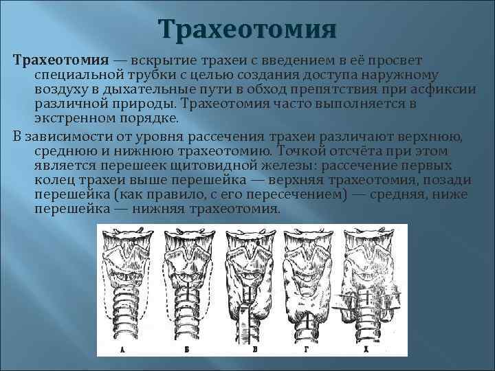 Трахеотомия — вскрытие трахеи с введением в её просвет специальной трубки с целью создания