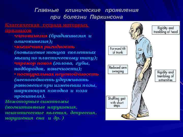 Главные клинические проявления при болезни Паркинсона Классическая тетрада моторных признаков • гипокинезия (брадикинезия и