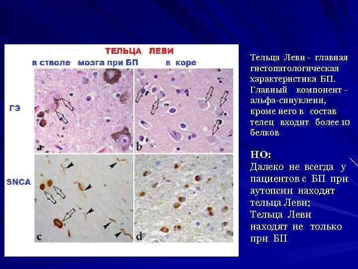 Тельца Леви - главная гистопатологическая характеристика БП. Главный компонент альфа-синуклеин, кроме него в состав