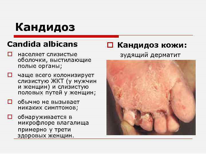 Кандидоз Candida albicans o населяет слизистые оболочки, выстилающие полые органы; o чаще всего колонизирует