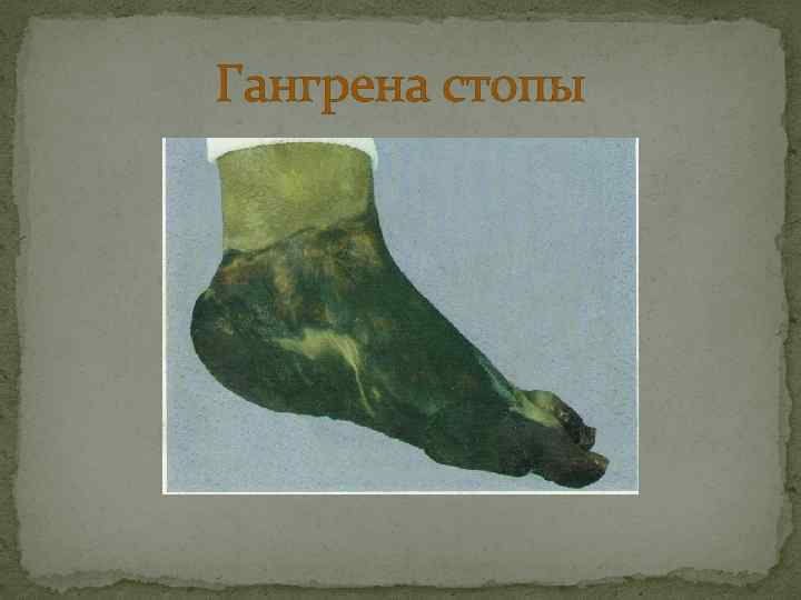 Гангрена стопы 