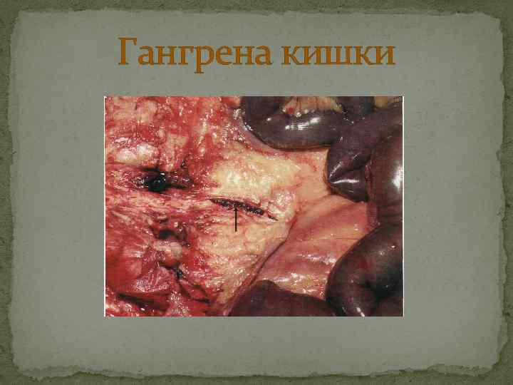 Гангрена кишки 