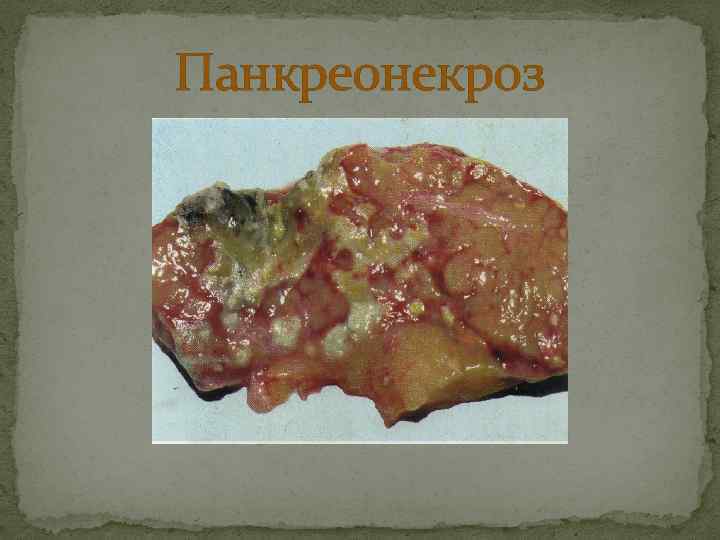 Панкреонекроз 