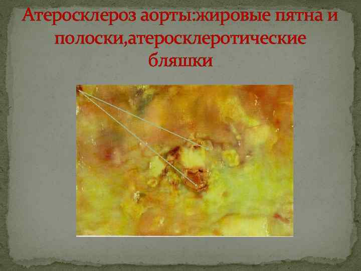 Атеросклероз аорты: жировые пятна и полоски, атеросклеротические бляшки 