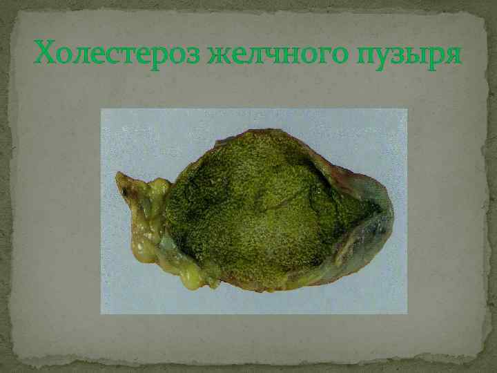 Холестероз желчного пузыря 