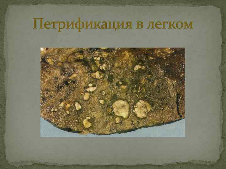 Петрификация в легком 