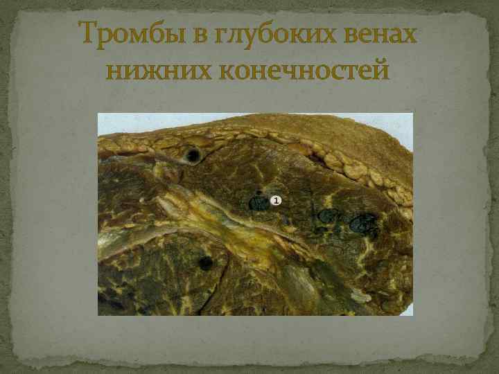 Тромбы в глубоких венах нижних конечностей 