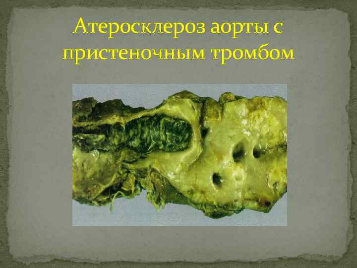 Атеросклероз аорты с пристеночным тромбом 