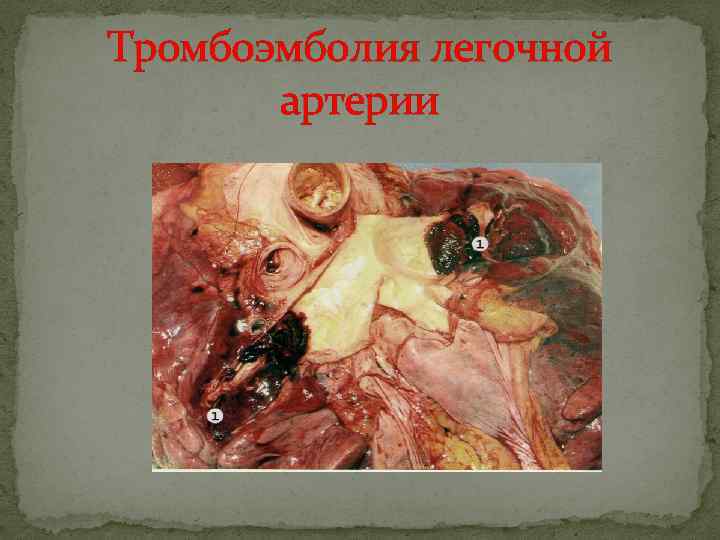 Тромбоэмболия легочной артерии 