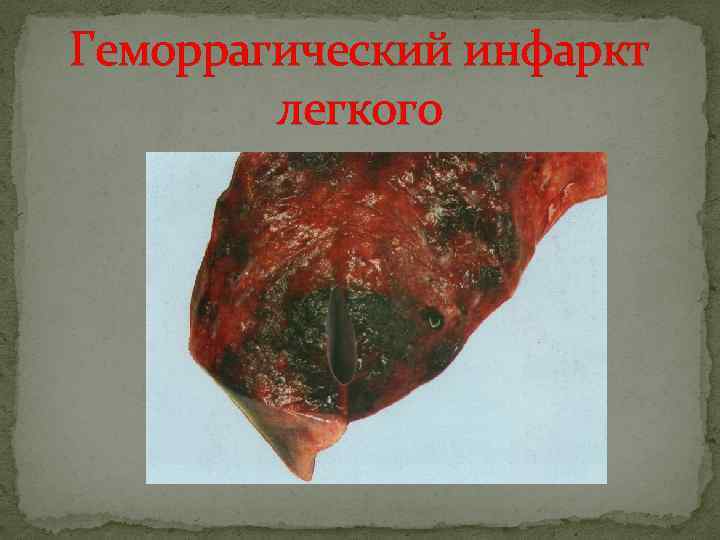 Геморрагический инфаркт легкого 