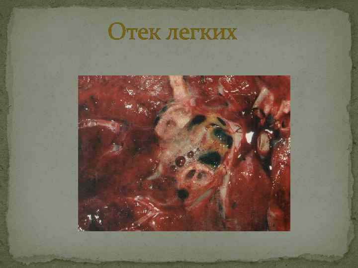 Отек легких 