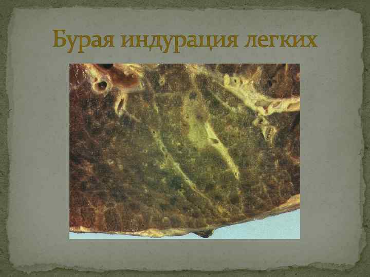 Бурая индурация легких 