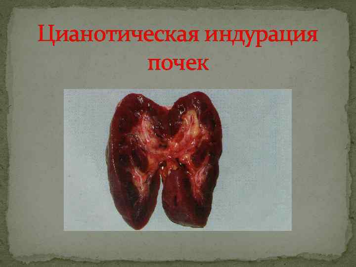 Цианотическая индурация почек 