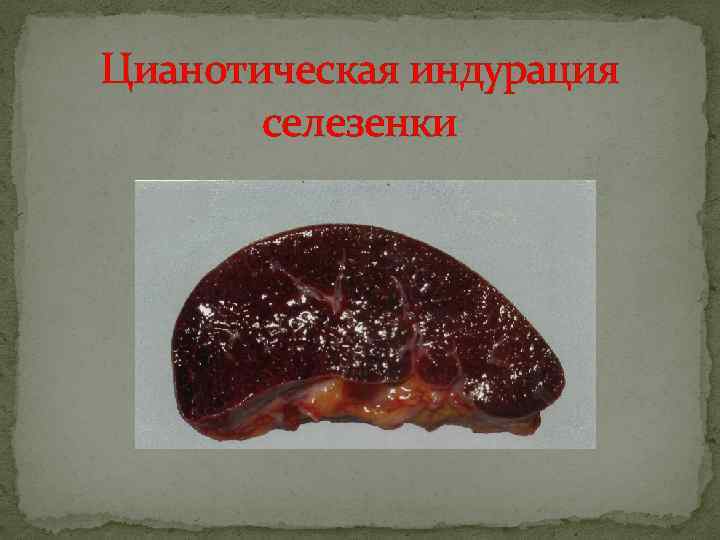 Цианотическая индурация селезенки 