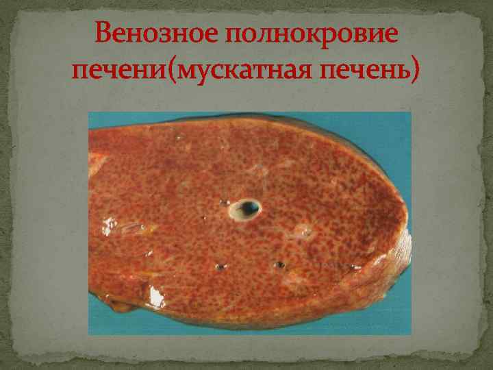 Венозное полнокровие печени(мускатная печень) 