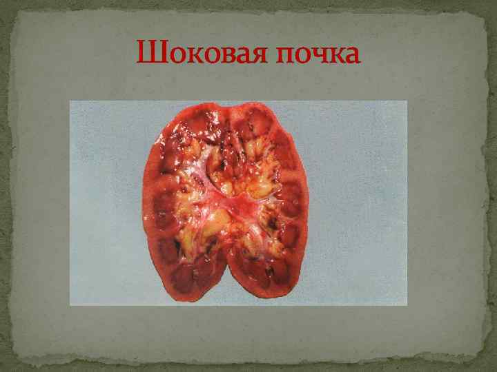 Шоковая почка 