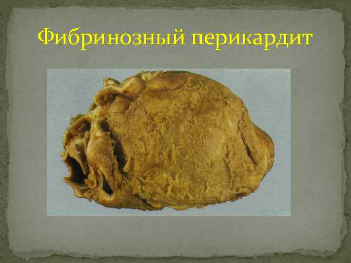 Фибринозный перикардит 