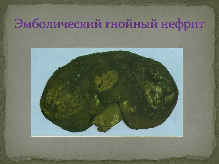 Эмболический гнойный нефрит 