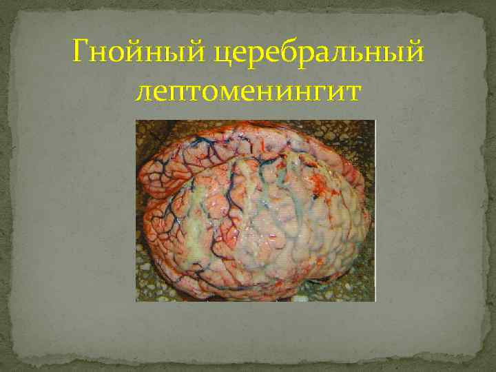 Гнойный церебральный лептоменингит 