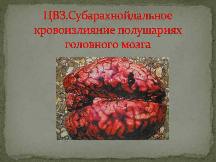 ЦВЗ. Субарахнойдальное кровоизлияние полушариях головного мозга 